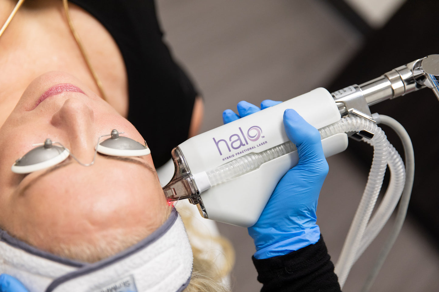 HALO Laser + BBL Single Session: Face, Neck or Chest (one area)