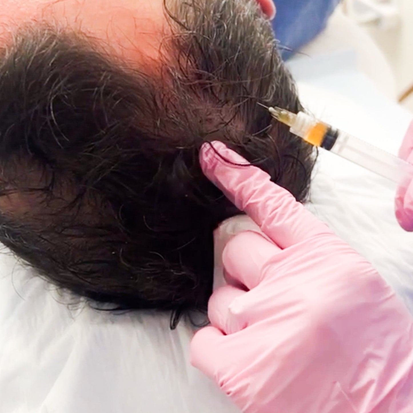 PRF Hair restoration